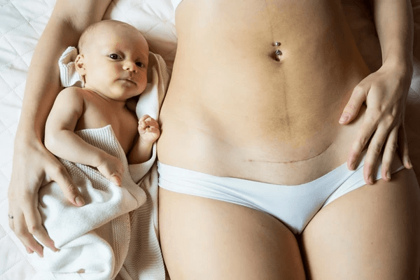 recuperation-apres-cesarienne-le-guide-complet-pour-une-convalescence-reussie